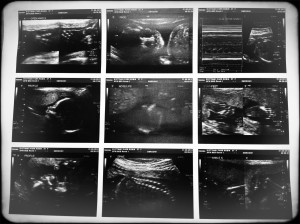 20-week-ultrasound-photos